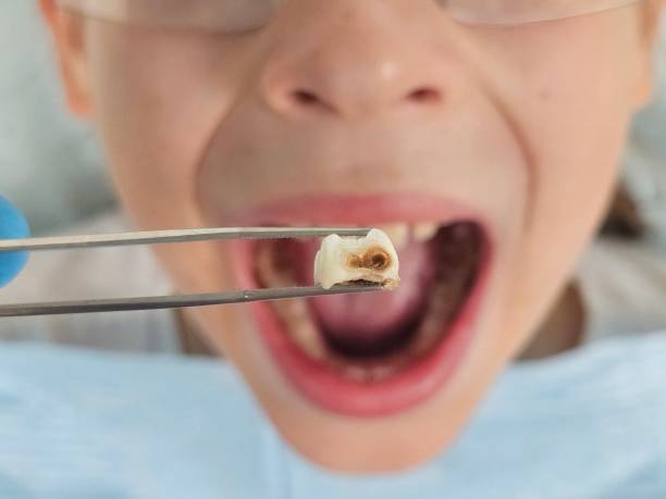 Best Emergency Tooth Extraction in Cambridge, MD